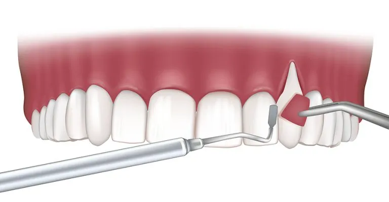 Gum Grafting: A Vital Regenerative Procedure for Restoring Gum Health