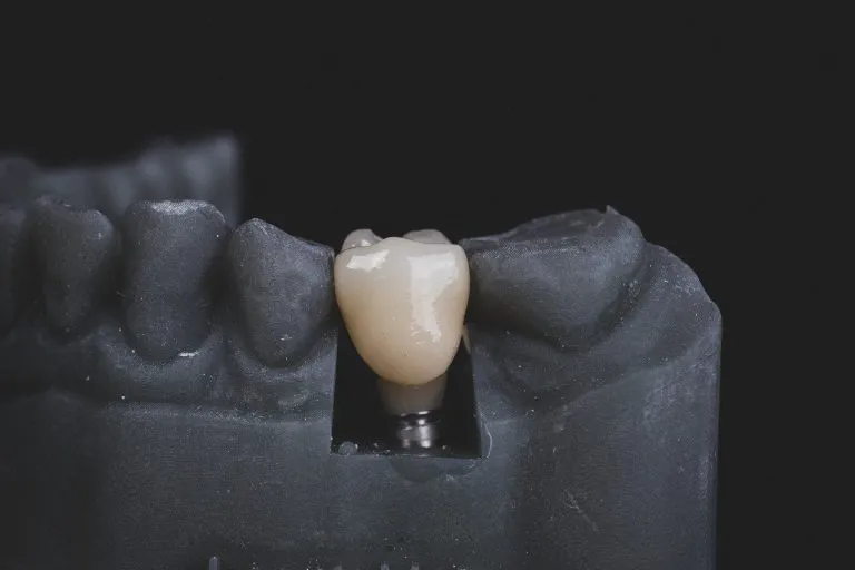 Why Dental Implants Are the Preferred Solution for Missing Teeth