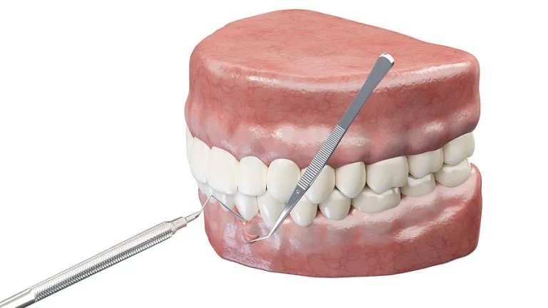 Regenerative Procedure (Gum Graft): Restoring Gum Health and Protecting Your Smile